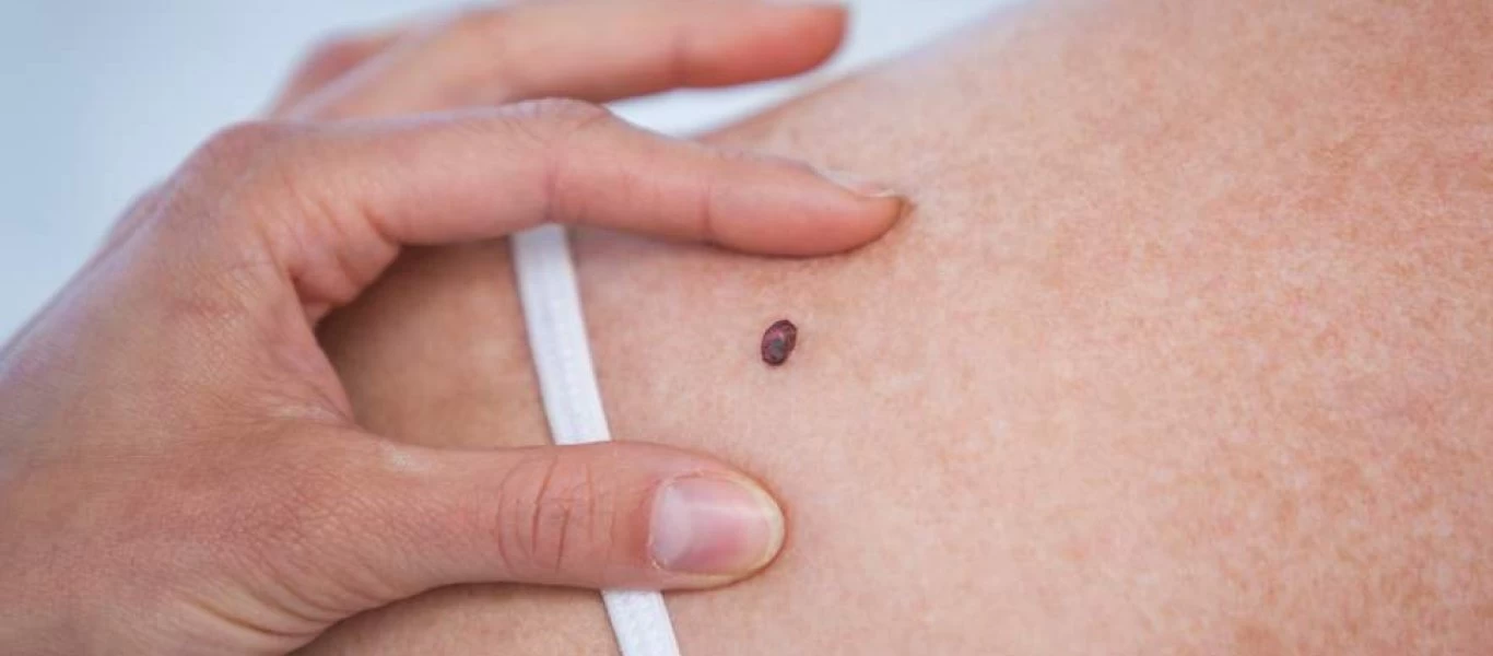 Επτά συμβουλές που βοηθούν στην πρόληψη του καρκίνου του δέρματος